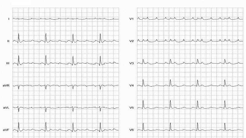 Atrial Flutter 12 Lead EKG